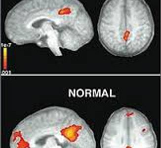 El desarrollo del autismo es diferente en el cerebro de niños y niñas